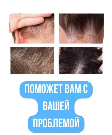 TheWeekend Cream for seborrhene dermatitis - Buy Online on GoSupps.com