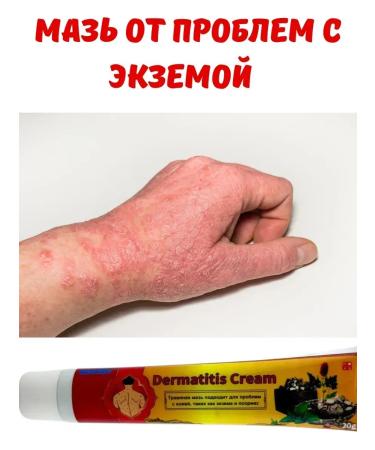 Golden Apple Ointment from psoriasis eczema and dermatitis 20g. Miracle - Buy Online on GoSupps.com