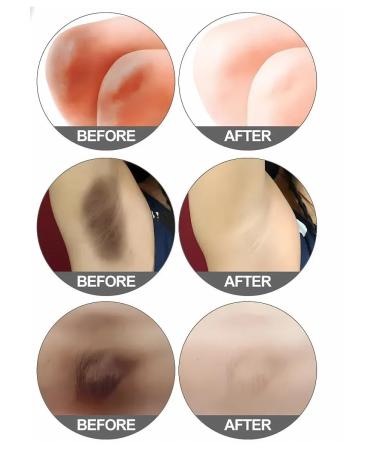 VALLEY Whitening cream for between the legs from the black spots of the knees of the elbows - Buy Online on GoSupps.com