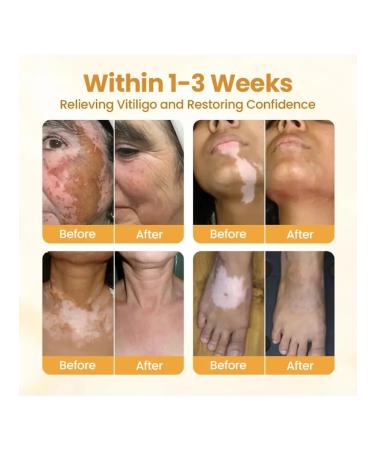 Bee cream for reducing white spots (2 bottles) - Buy Online on GoSupps.com