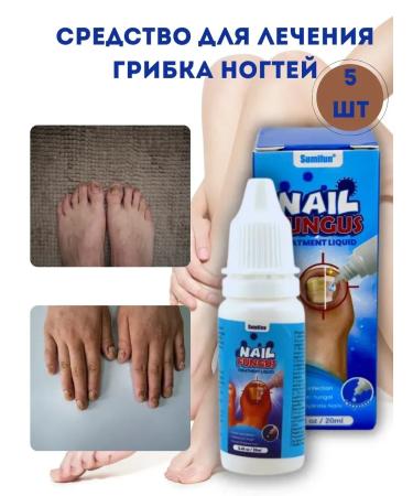 Kalis Feetor for the treatment of nail fungus