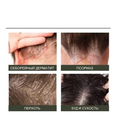 Life Cream ointment from itching dandruff on the head seborrheic dermatitis - Buy Online on GoSupps.com