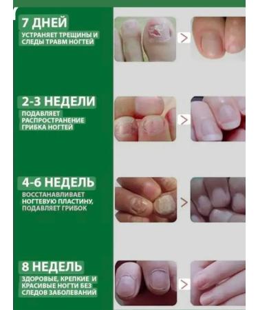 Gintensive Ointment from the fungus on the legs between the fingers from the smell of the legs - Buy Online on GoSupps.com