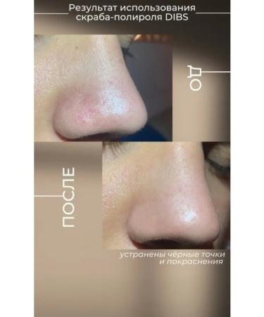 Dibs cosmetics Acid peeling for face and scalp exfoliating cosmetics for hair care cleansing and pore tightening - Buy Online on GoSupps.com