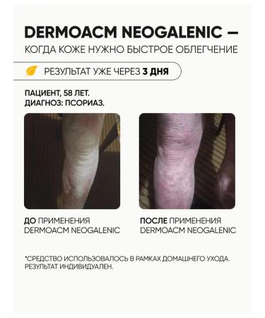 DermoACM Gel for dry and problematic skin with hyperkeratosis psoriasis - Buy Online on GoSupps.com