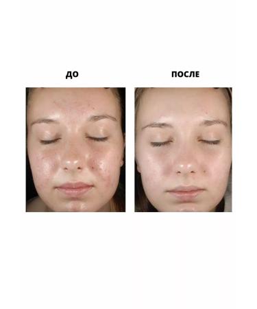 The ordinary Mandelic Acid's almond acid peeling 10% +HA - Buy Online on GoSupps.com