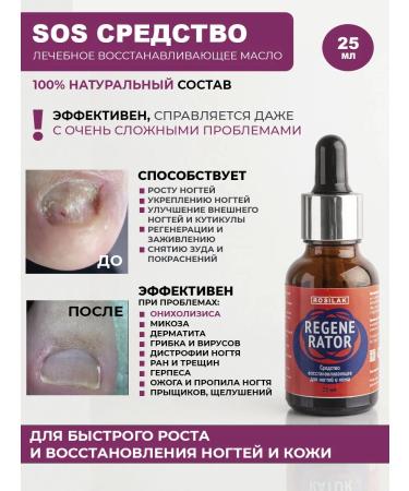 Rosilak Oil for growing nails strengthening oncholysis