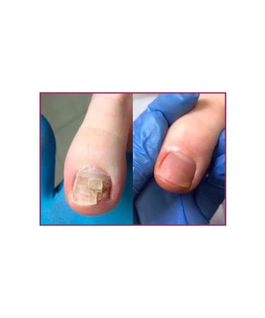 Rosilak Oil for growing nails strengthening oncholysis - Buy Online on GoSupps.com