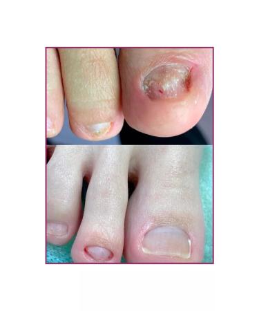 Rosilak Oil for growing nails strengthening oncholysis - Buy Online on GoSupps.com