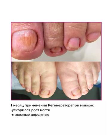 Rosilak Oil for growing nails strengthening oncholysis - Buy Online on GoSupps.com