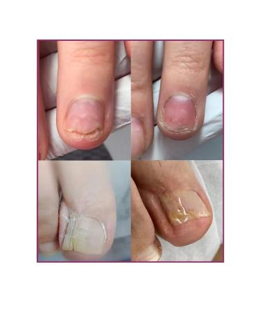 Rosilak Oil for growing nails strengthening oncholysis - Buy Online on GoSupps.com