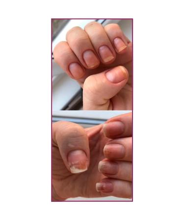 Rosilak Oil for growing nails strengthening oncholysis - Buy Online on GoSupps.com