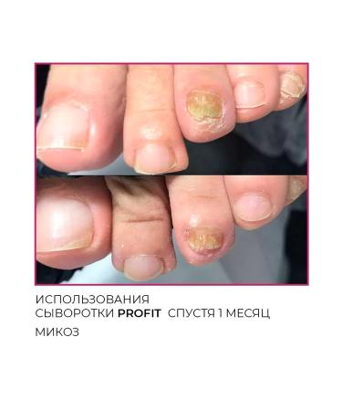 Rosilak Remedy for toenail fungus - Buy Online on GoSupps.com