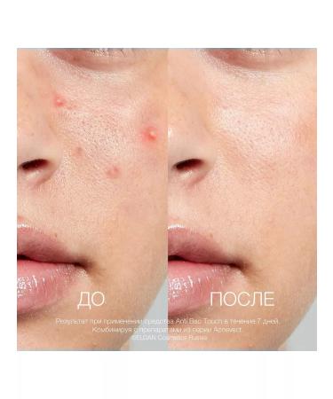 Eldan Cosmetics Eldan for face from inflammation and acne Anti-Bac Touch 10 ml - Buy Online on GoSupps.com