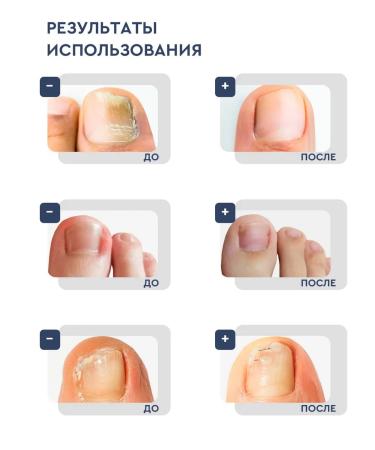 INKI Balm for softening an ingrown nail and caring for a cuticle - Buy Online on GoSupps.com