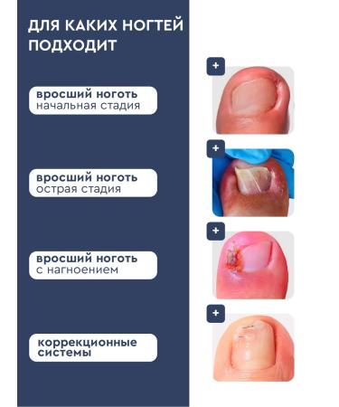 INKI A tool for softening an ingrown nail with collagen - Buy Online on GoSupps.com