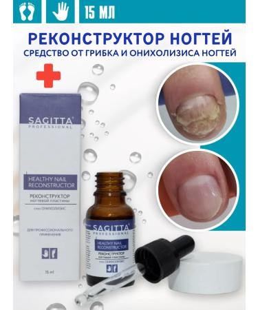 Remedy for nail fungus on the legs and hands of the feet onycholysis