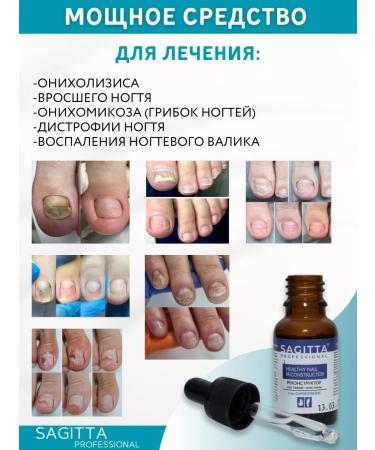 Remedy for nail fungus on the legs and hands of the feet onycholysis - Buy Online on GoSupps.com