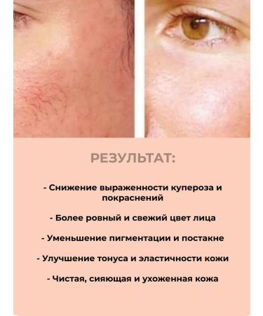 RENEV SYSTEM Facial peeling from rosacea acne post -acne Azeline 15% - Buy Online on GoSupps.com