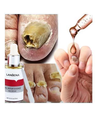LANBENA From nail fungus on the legs 15 ml - Buy Online on GoSupps.com
