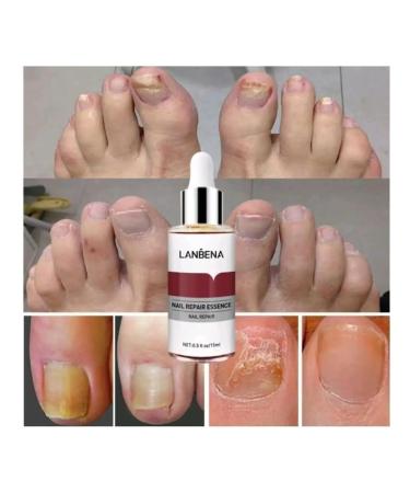 LANBENA From nail fungus on the legs 15 ml - Buy Online on GoSupps.com