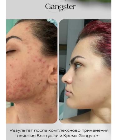 Gangster77 Set of acne and acne lotion and gangster moisturizer - Buy Online on GoSupps.com