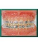 Morgan Bumper Braces Cover Lip Protector - Set of 2, Clear - Buy Online on GoSupps.com