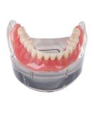 Dental Teeth Model - Lower Removable Overdenture with 2 Implants | Dentist Assistant Supplies - International Shipping - Buy Online on GoSupps.com