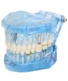 Adult Dental Implant Tooth Model - Blue-Transparent Acrylic for Pedagogical Demonstration | Removable Simulation for Dentists - Buy Online on GoSupps.com