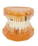 Dpofirs Orange Dental Model - Removable Teaching Tool for Dental Programs Adult Tooth Demonstration & Dental Implants - Buy Online on GoSupps.com