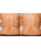 Skinnies Instant Lifts - 5 Pair Back Lifts - PATENTED MADE USA FLATTENS BACK FAT INSTANTLY Clear Adhesive Strips Instantly Smooth Back Fat. Go Backless! - Buy Online on GoSupps.com