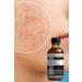 Puredermine Salicylic Acid & Dull Clogged Pores & Blackheads & Acne Serum & Niacinamide + Ha