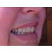 Instant White Smile Wholesale DIY Thermo-molding Boil and Bite Mouth Trays - Pack of 10 - Buy Online on GoSupps.com