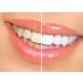 SmartSmiles Professional 3D Teeth Whitening Kit - Complete At-Home Whitening System - Buy Online on GoSupps.com