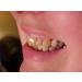 Instant White Smile Wholesale DIY Thermo-molding Boil and Bite Mouth Trays - Pack of 10 - Buy Online on GoSupps.com