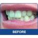 10 3ml Syringes Teeth Whitening Kit with 44% Carbamide Gel by White Teeth Global - Professional Dental Bleaching Treatment - Buy Online on GoSupps.com