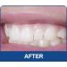 Professional 36% Teeth Whitening Kit - Instant White Smiles - 2 Sets of Trays - 40ml Syringes - Buy Online on GoSupps.com