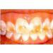 Instant White Smile Wholesale DIY Thermo-molding Boil and Bite Mouth Trays - Pack of 10 - Buy Online on GoSupps.com