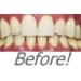 Professional 36% Teeth Whitening Kit - Instant White Smiles - 2 Sets of Trays - 40ml Syringes - Buy Online on GoSupps.com