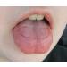 RPE Tongue Guard - Prevents and Heals Tongue Sores from Dental Expanders - Buy Online on GoSupps.com