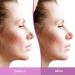 Discover Differin Resurfacing Acne Scar Spot Treatment Gel 1.0 oz - Elevate Your Style Instantly! - Buy Online on GoSupps.com