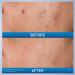 CeraVe Acne Control Gel Blemish Treatment with AHA & BHA for Acne Prone Skin 1.35 oz - Transform Your Style with the Best Innovation Today! - Buy Online on GoSupps.com