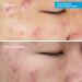 Discover Murad Deep Relief Acne Treatment with Soothing Phytosteroid 1.0 oz - Elevate Your Style Instantly! - Buy Online on GoSupps.com