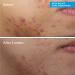 Discover Murad Deep Relief Acne Treatment with Soothing Phytosteroid 1.0 oz - Elevate Your Style Instantly! - Buy Online on GoSupps.com