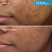 Discover Murad Deep Relief Acne Treatment with Soothing Phytosteroid 1.0 oz - Elevate Your Style Instantly! - Buy Online on GoSupps.com