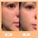 good light Luna Fast Acting Pimple Patches 24 ct - Transform Your Style with the Best Innovation Today! - Buy Online on GoSupps.com