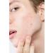 Discover Hero Cosmetics Mighty Patch Micropoint for Blemishes Patches 8 ct - Elevate Your Style Instantly! - Buy Online on GoSupps.com