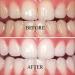 Natural Elegance Plus Mint Teeth Whitening Gel 2-Pack - 22% Carbamide Peroxide by Henry Schein | Reduced Sensitivity Formula | Compare to Opalescence Dramatic Professional Whitening - Buy Online on GoSupps.com