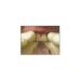 Buy Opalescence PF 20% Teeth Whitening 8pk & D.I.Y. Tray Kit - Professional Whitening Solution for a Brighter Smile Worldwide - Buy Online on GoSupps.com