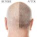  EXCELDIET PHARMA Hair Loss for Men and Women - Hair and Nails - High-Dosed Hair Food Supplement with Methionine and Cysteine Vitamins - 120 Vegetable Capsules Made in France - Buy Online on GoSupps.com
